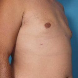 gynecomastia-dr-daniel-man-trsaside1-jpg