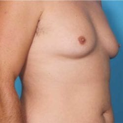 gynecomastia-dr-daniel-man-trsaside1-copy-jpg