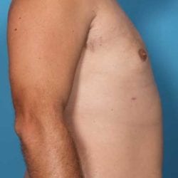 gynecomastia-dr-daniel-man-trsaside2-jpg