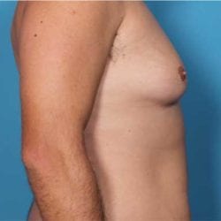 gynecomastia-dr-daniel-man-trsaside2-copy-jpg