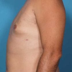gynecomastia-dr-daniel-man-trsaside3-jpg