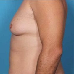 gynecomastia-dr-daniel-man-trsaside3-copy-jpg