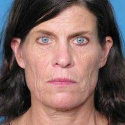 lip-lift-dr-daniel-man-kdfront1-copy-jpg