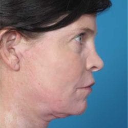 lip-lift-dr-daniel-man-kdside1-jpg