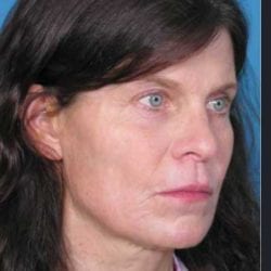 lip-lift-dr-daniel-man-kdside2-jpg