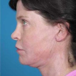 lip-lift-dr-daniel-man-kdside3-jpg