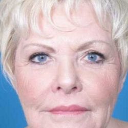 lip-lift-dr-daniel-man-sstfront1-jpg