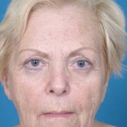 lip-lift-dr-daniel-man-sstfront1-copy-jpg