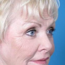 lip-lift-dr-daniel-man-sstside1-jpg