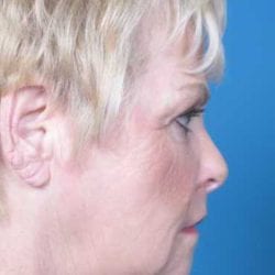 lip-lift-dr-daniel-man-sstside2-jpg