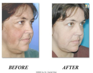 DMMD Before and After Pictures Boca Raton, FL