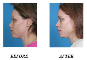 MD Facial Treatments in Boca Raton, FL