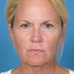 refit-relift_before_2