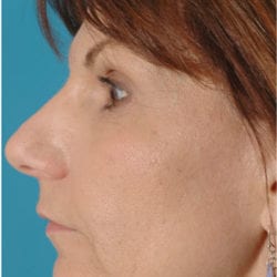 sculptra-case2-side3-jpg