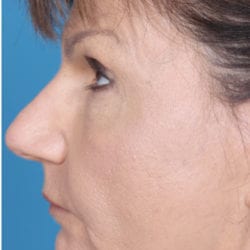 sculptra-case2-side3after-jpg