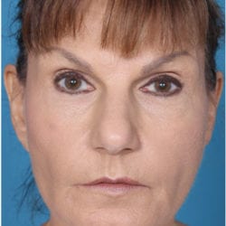 sculptra-case2after-jpg