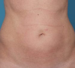 tickle-lipo_before_1