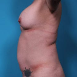 tummytuck_10_3_before