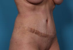tummytuck_9_2_after