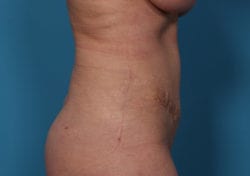 tummytuck_9_3_after