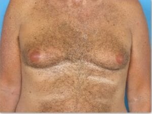 Male Breast Before and After Result | Daniel Man MD | Gynecomastia | Boca Raton, FL