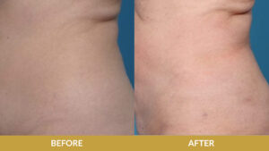 Liposuction Before & After Result | Daniel Man MD | Tickle Liposuction | Boca Raton, FL