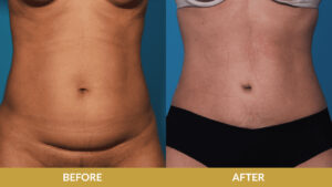 Muscle Tightening Before & After Result | Daniel Man MD | Tummy Tuck | Boca Raton, FL