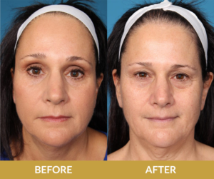 Saggy Eyelids Before & After Result | Daniel Man MD | Blepharoplasty | Boca Raton, FL