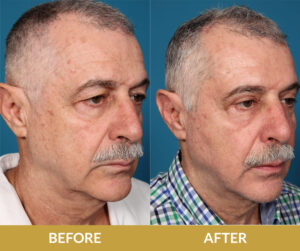 Saggy Eyelids Before & After Result | Daniel Man MD | Blepharoplasty | Boca Raton, FL