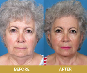 Before and After Result | Daniel Man MD | Face and Neck Lift | Boca Raton, FL