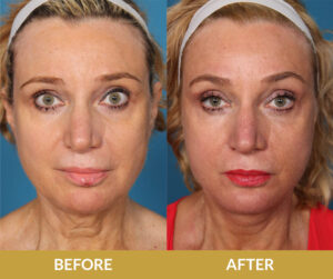Eyelids Before & After Result | Daniel Man MD | Blepharoplasty | Boca Raton, FL