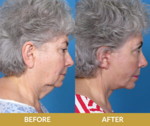 Before and After Result | Daniel Man MD | Face and Neck Lift | Boca Raton, FL
