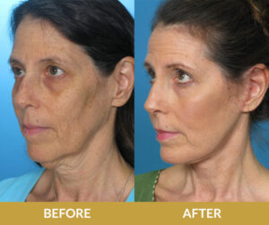 Face and Neck Lift | Daniel Man MD | Dermabrasion and Peel | Boca Raton, FL