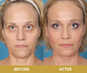 Face and Neck Lift | Daniel Man MD | Dermabrasion and Peel | Boca Raton, FL