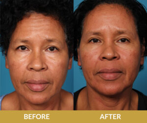 Saggy Eyelids Before & After | Daniel Man MD | Blepharoplasty | Boca Raton, FL