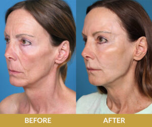 Saggy Eyelids Before & After | Daniel Man MD | Blepharoplasty | Boca Raton, FL