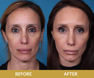 Droopy Eyelids Before & After | Daniel Man MD | Blepharoplasty | Boca Raton, FL