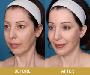 Blepharoplasty Before & After | Daniel Man MD | Face Lift & DMMD Skin Treatment | Boca Raton, FL