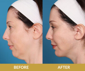Blepharoplasty Before & After | Daniel Man MD | DMMD Skin Treatment | Boca Raton, FL