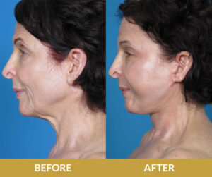 Endoscopic Lift Before & After | Daniel Man MD | DMMD Skin Treatment | Boca Raton, FL