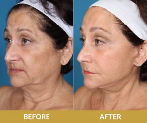 Endoscopic Lift Before & After | Daniel Man MD | DMMD Skin Treatment | Boca Raton, FL