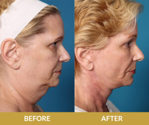 Blepharoplasty Before & After | Daniel Man MD | DMMD Skin Treatment | Boca Raton, FL