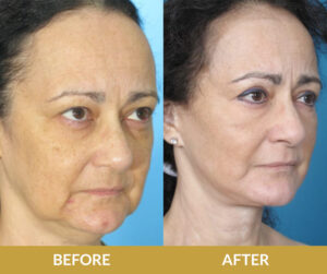 Natural Face and Neck Lift | Daniel Man MD | Blepharoplasty and DMMD Skin Treatment | Boca Raton, FL
