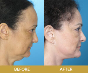 Natural Face and Neck Lift | Daniel Man MD | Blepharoplasty and DMMD Skin Treatment | Boca Raton, FL