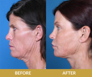 Face and Neck Lift Before & After | Daniel Man MD | Endoscopic Forehead Lift | Boca Raton, FL