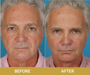 Blepharoplasty Before & After Result | Daniel Man MD | Face and Neck Lift | Boca Raton, FL